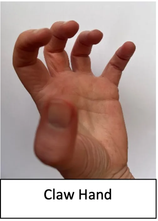 Claw_hand